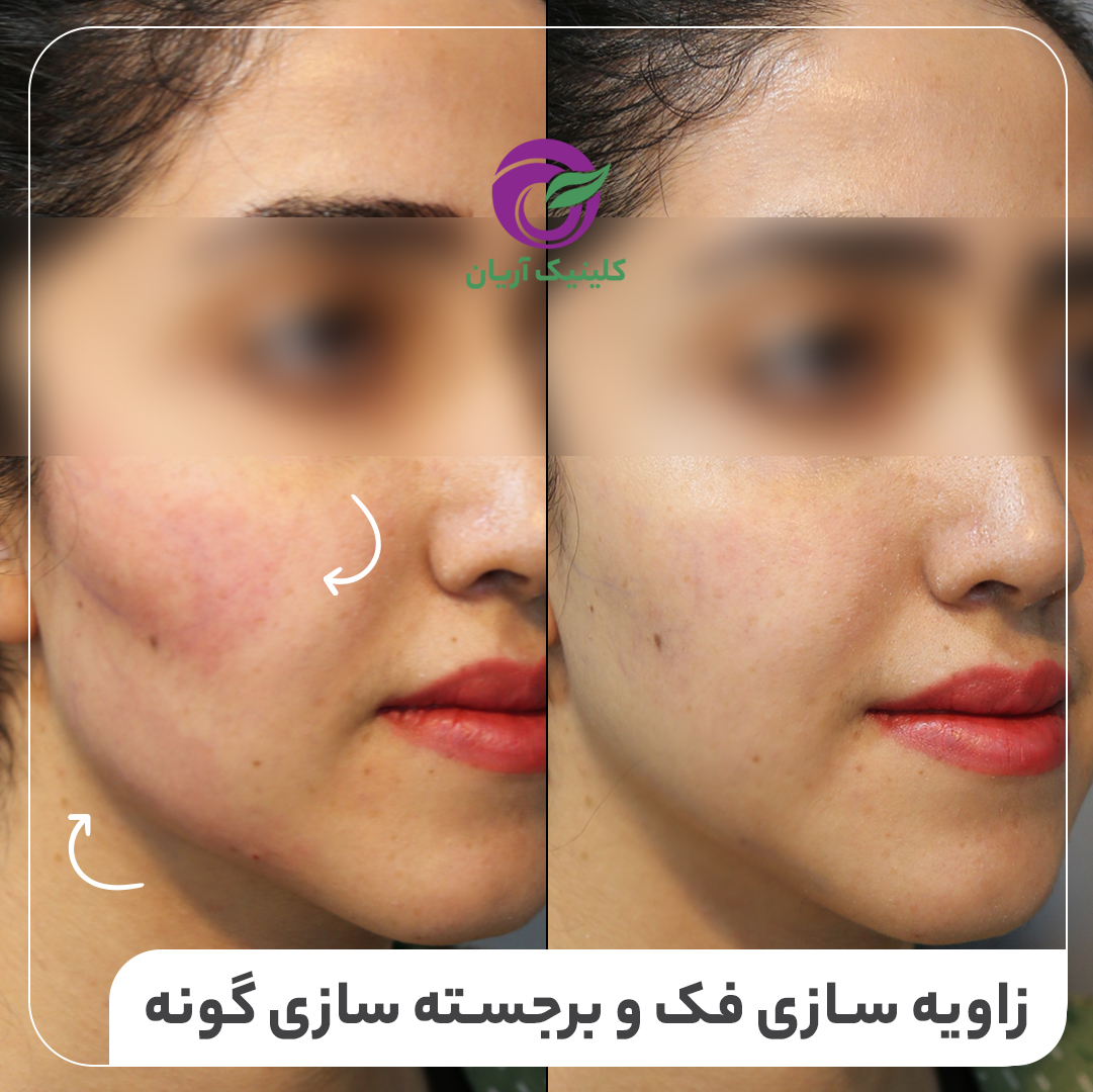 تصاویر قبل و بعد از تزریق ژل